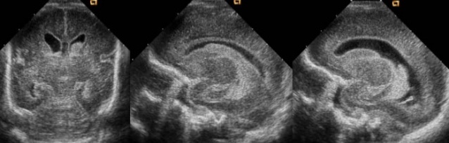 karanial-transkranial-transfontanel-ultrason