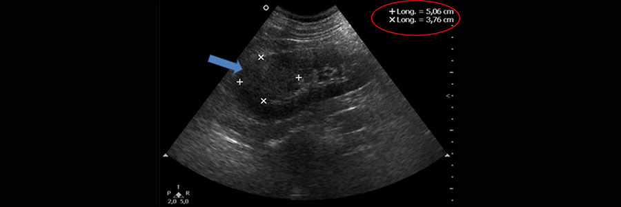 ultrasonda renal hipertansiyon