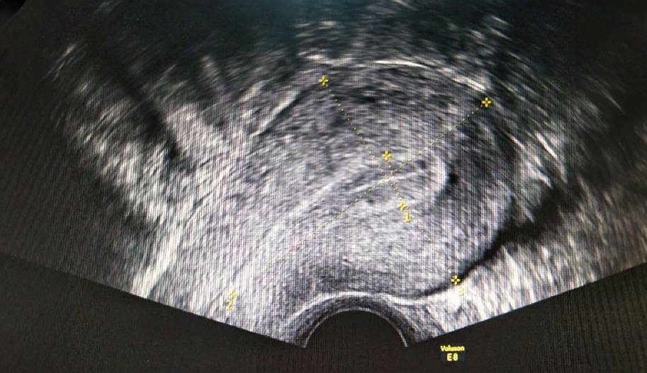 transvajinal-rrenkli-doppler