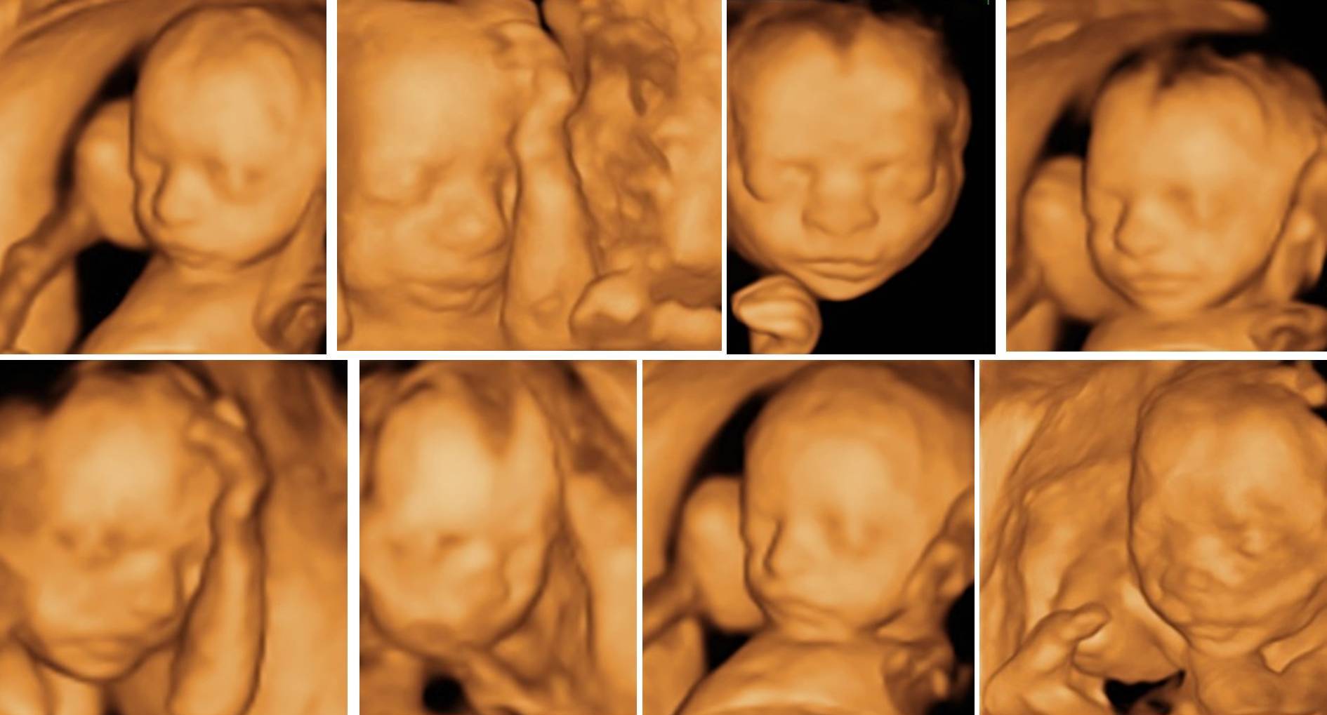 Mistillid Stor eg legemliggøre 20th Week Detailed Pregnancy Ultrasonography (Fetal Anomaly Scanning) -  Hekimoglu Imaging Center