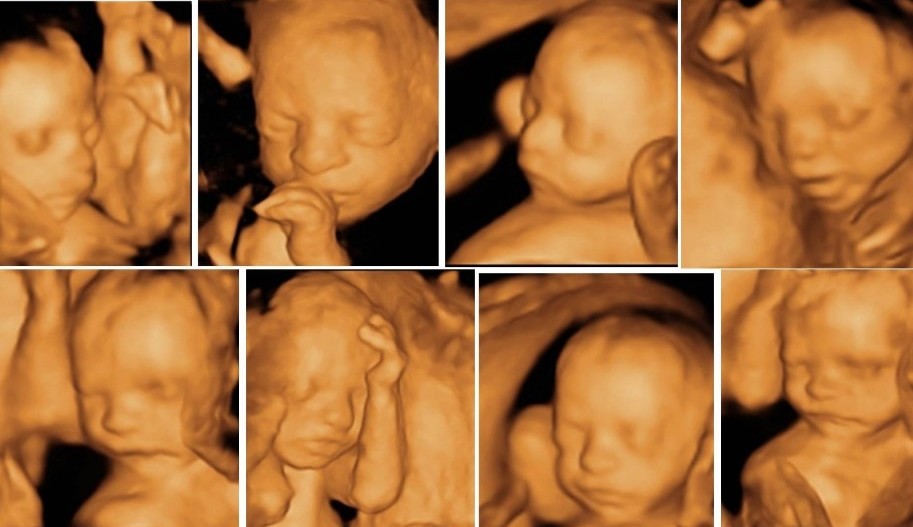 4-boyutlu-ayrıntılı-renkli-detaylı-ultrason3