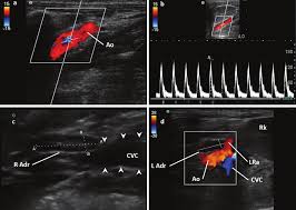 abdominal aort renkli doppler ultrason