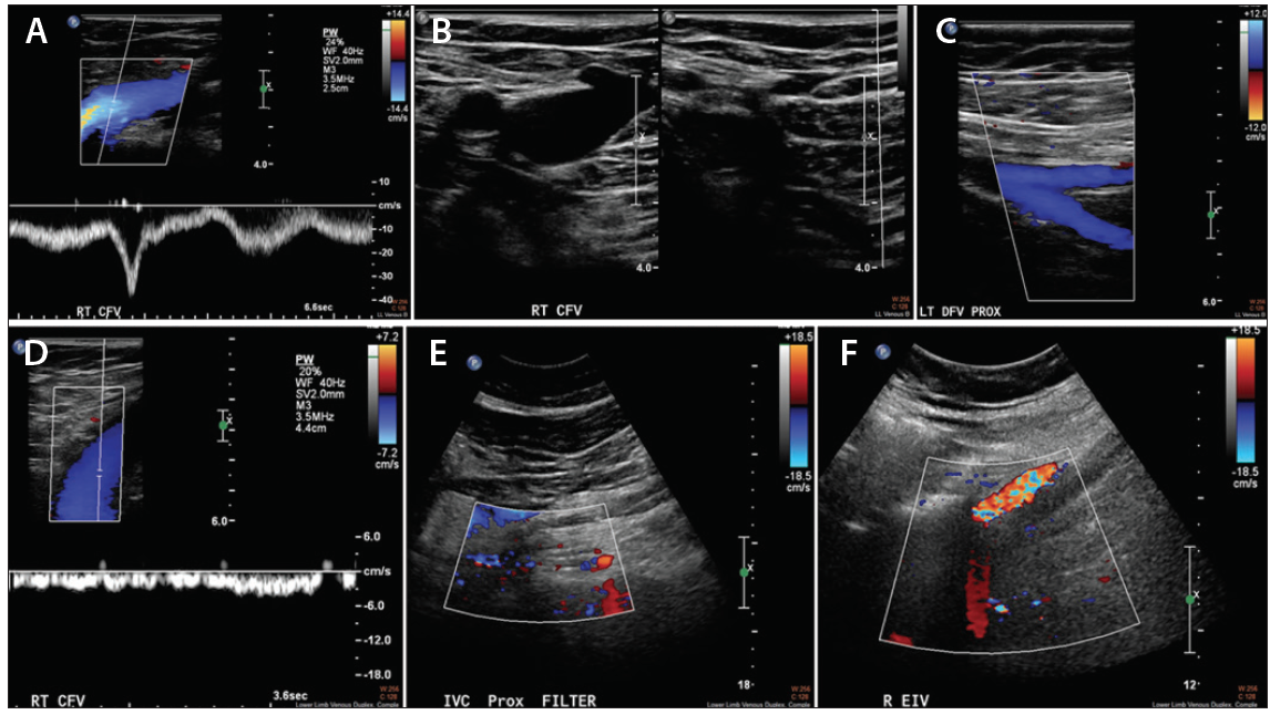 Hipertansiyonlu böbrek damarlarının ultrasonu