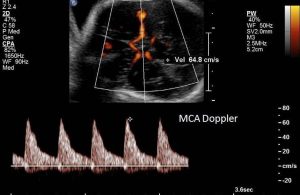 obstetrik doppler ultrason