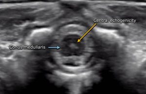 spinal sakral ultrason hakkında bilgi veriyor