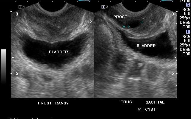 transrektal ultrason