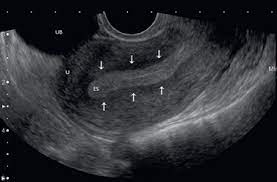 transvajinal ultrason
