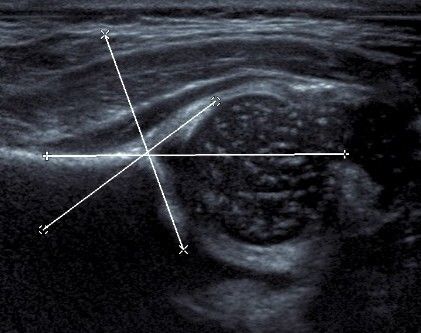 yenidoğan kalça ultrasonografisi