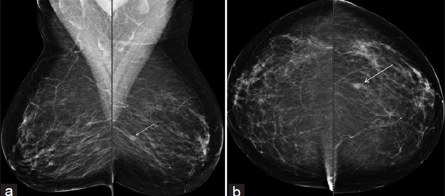 dijital mammografi