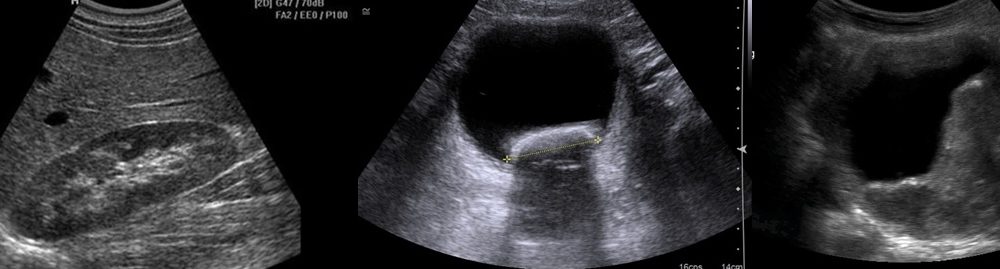 uriner sistem ultrasonu