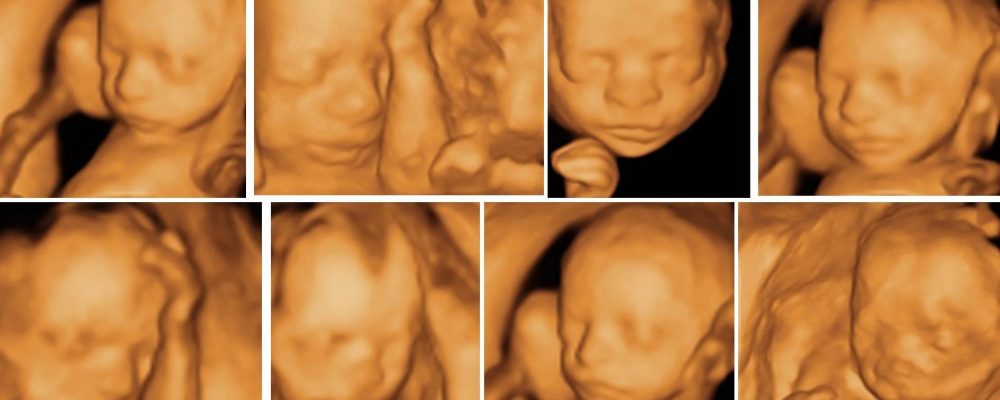 20 hafta ayrıntılı gebelik ultrasonografisi fetal anomali tarama