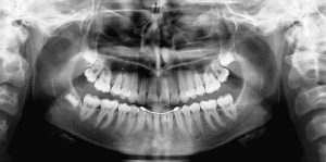 Panaromik diş röntgeni