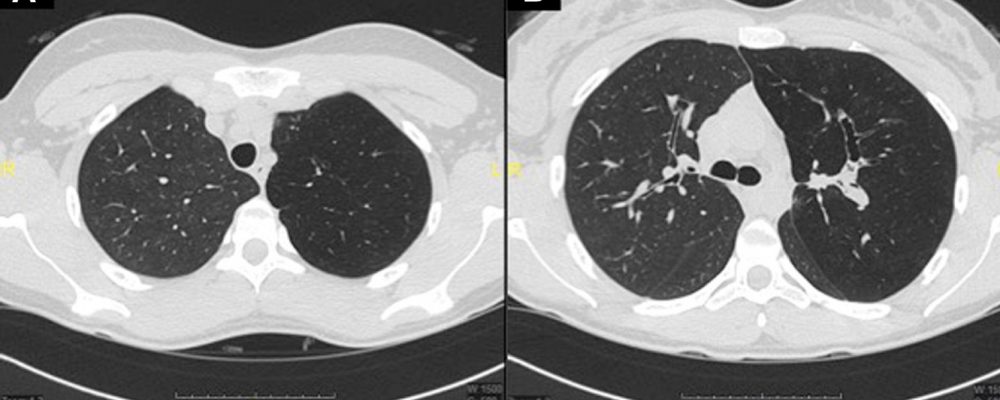 akciğer tomografisi fiyatları