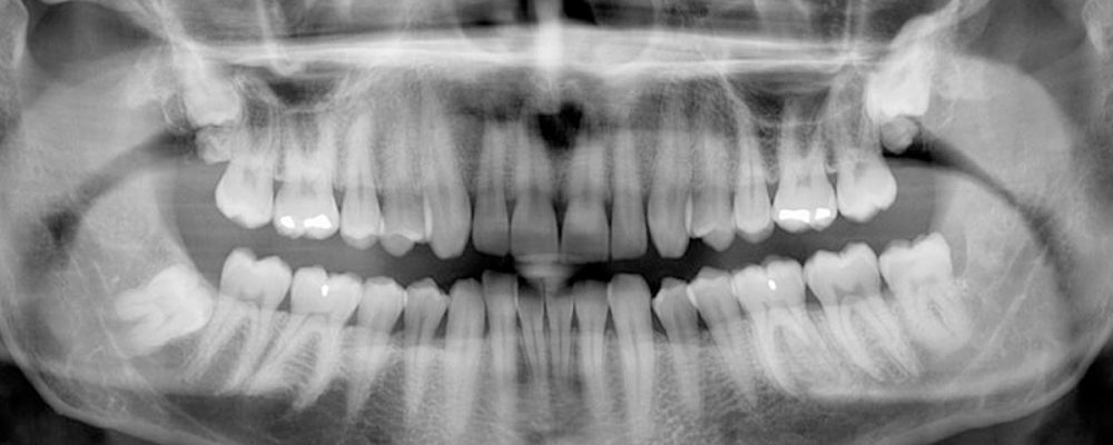 diş röntgeni ücreti