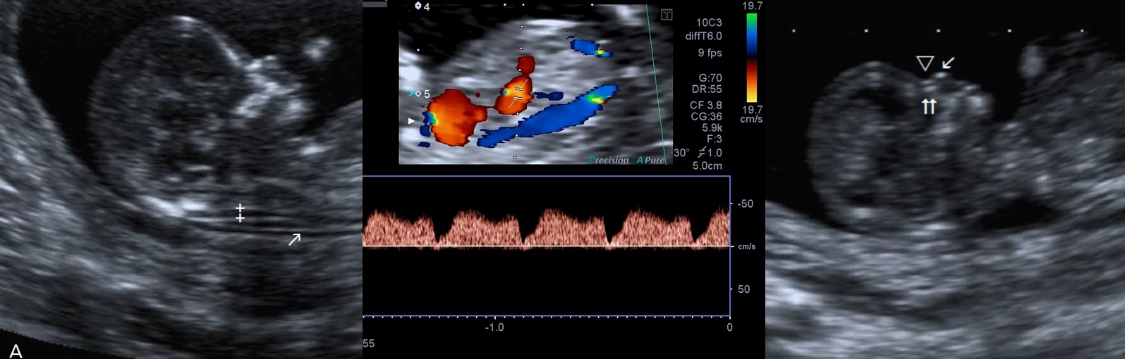 İkili-Test-Taraması-11-14-hafta-tarama-testiense-kalınlığı-testi