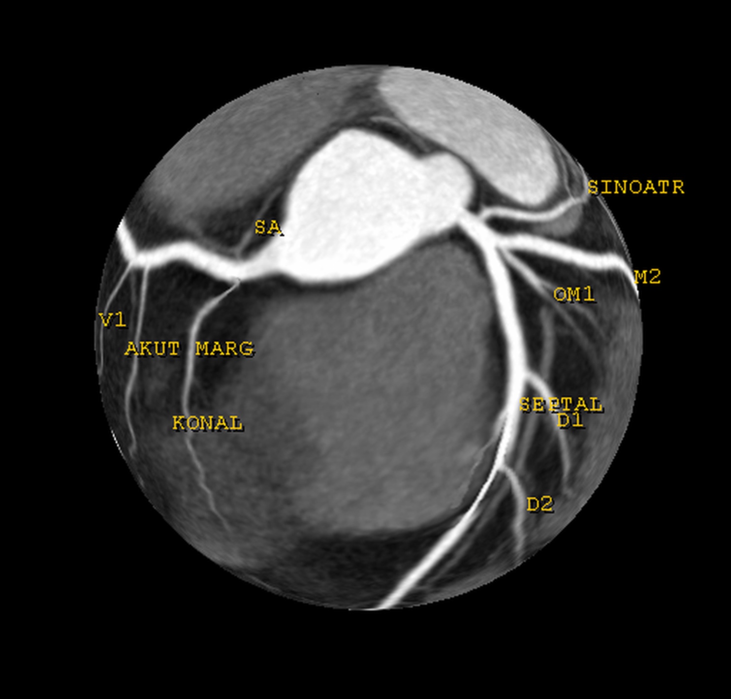 Sol-Kalp-Ventrikuler-Anjiyografi
